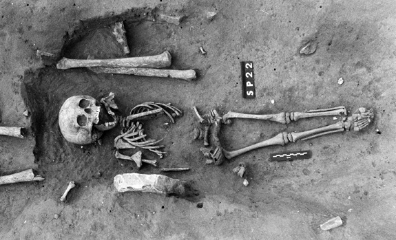 The skeleton of the earliest known case of Down syndrome is offering clues about how ancient communities looked at those with the chromosomal disorder, researchers say. (International Journal of Paleopathology)